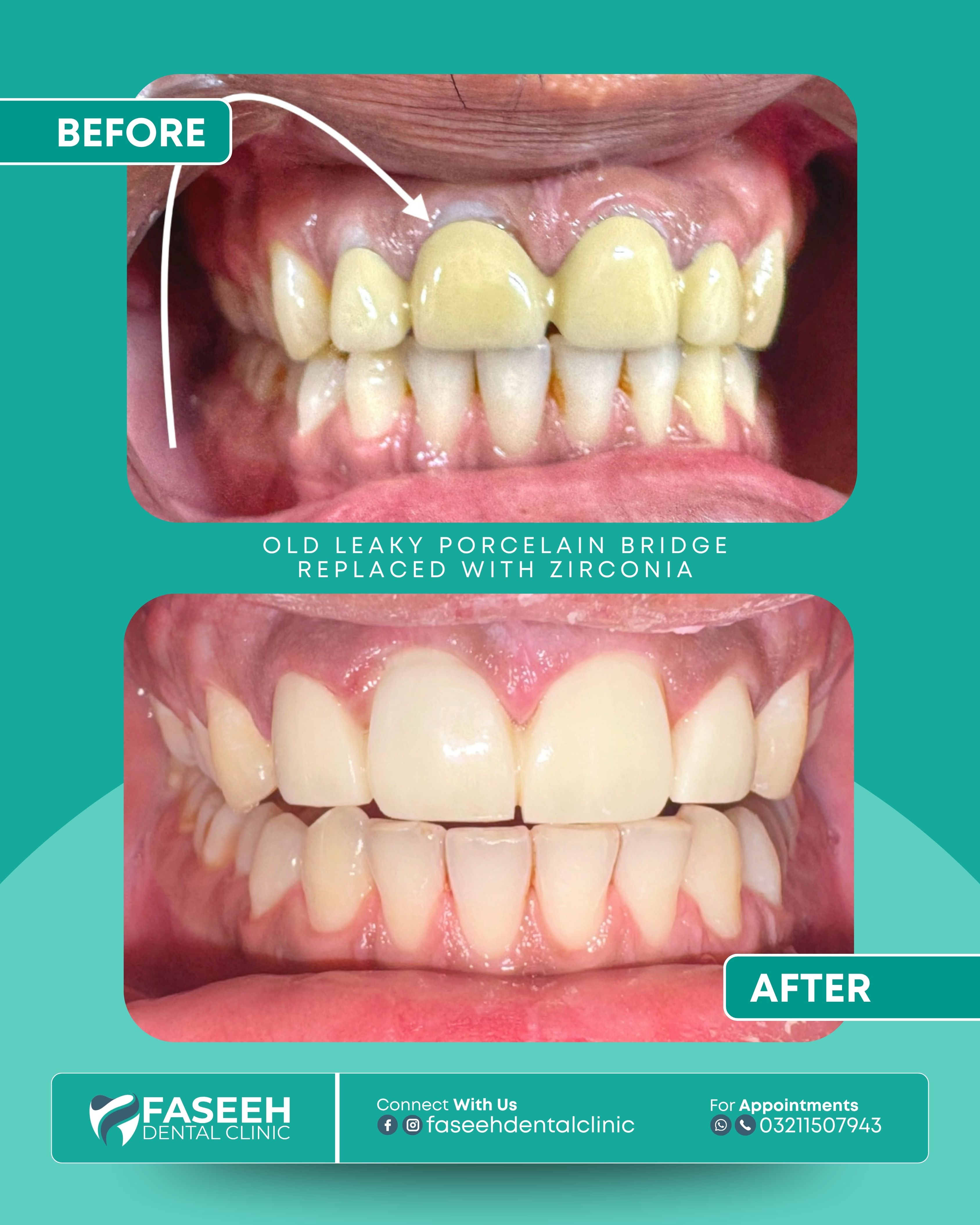 Dental bridge before and after