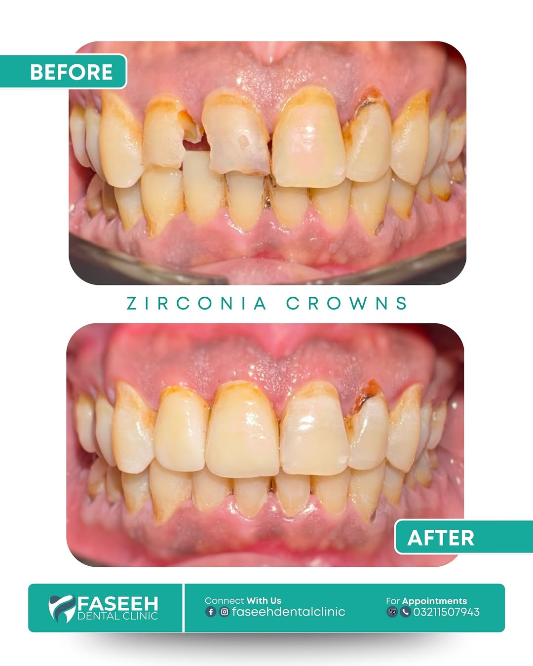 Dental crown before and after