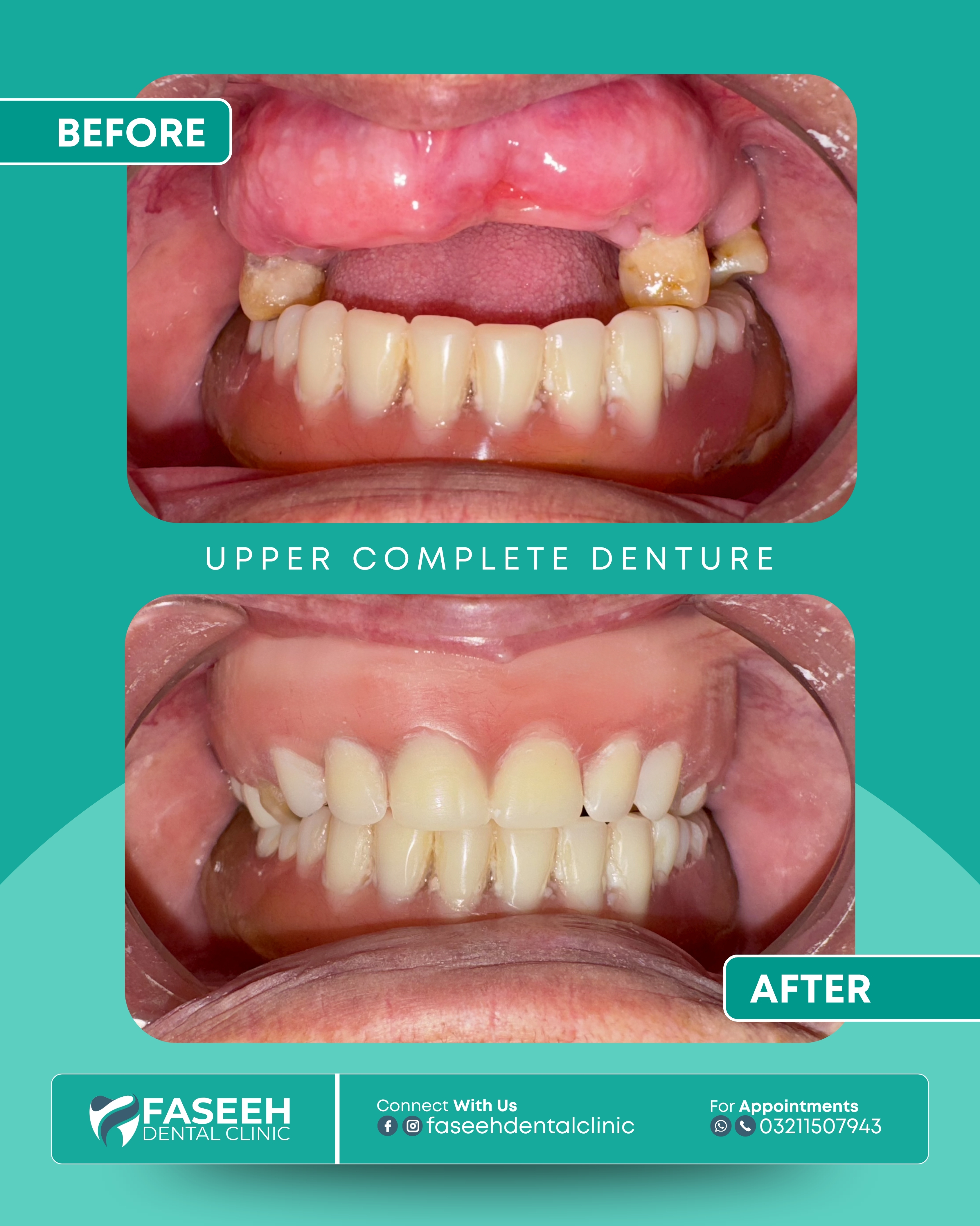 Dentures before and after