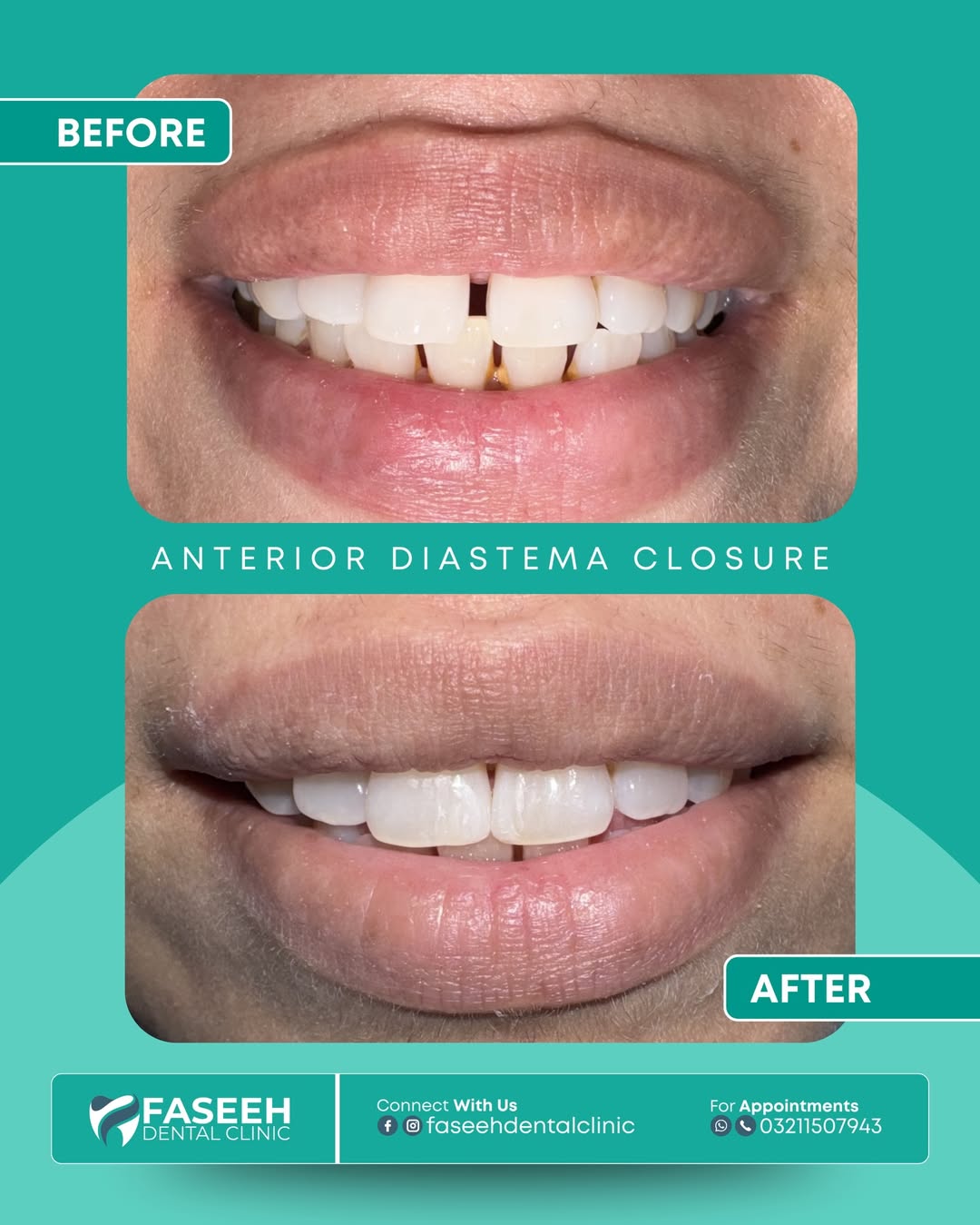 Diastema closure before and after