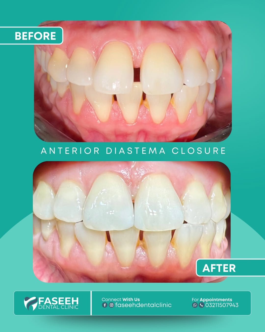 Diastema closure before and after