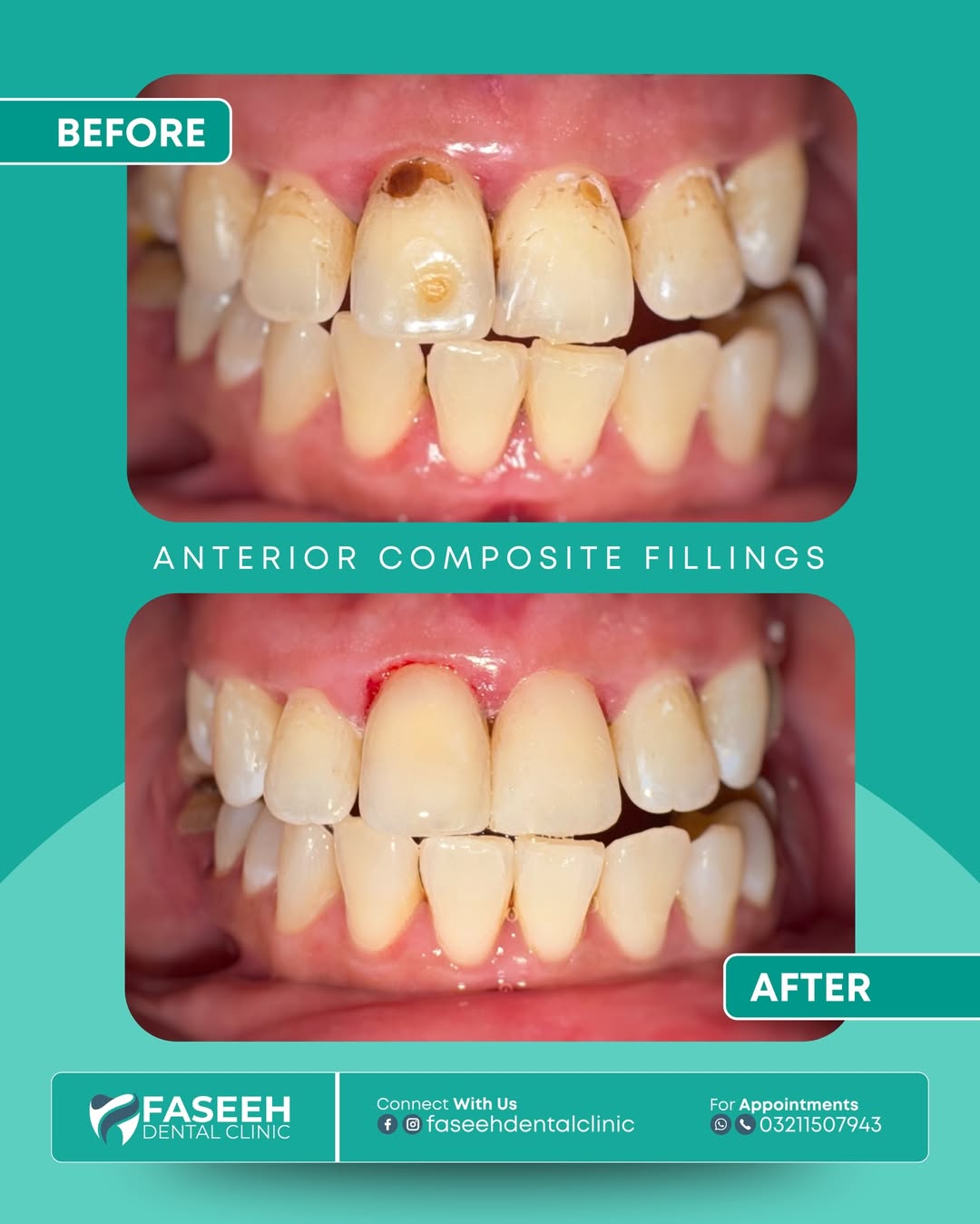 Dental fillings before and after