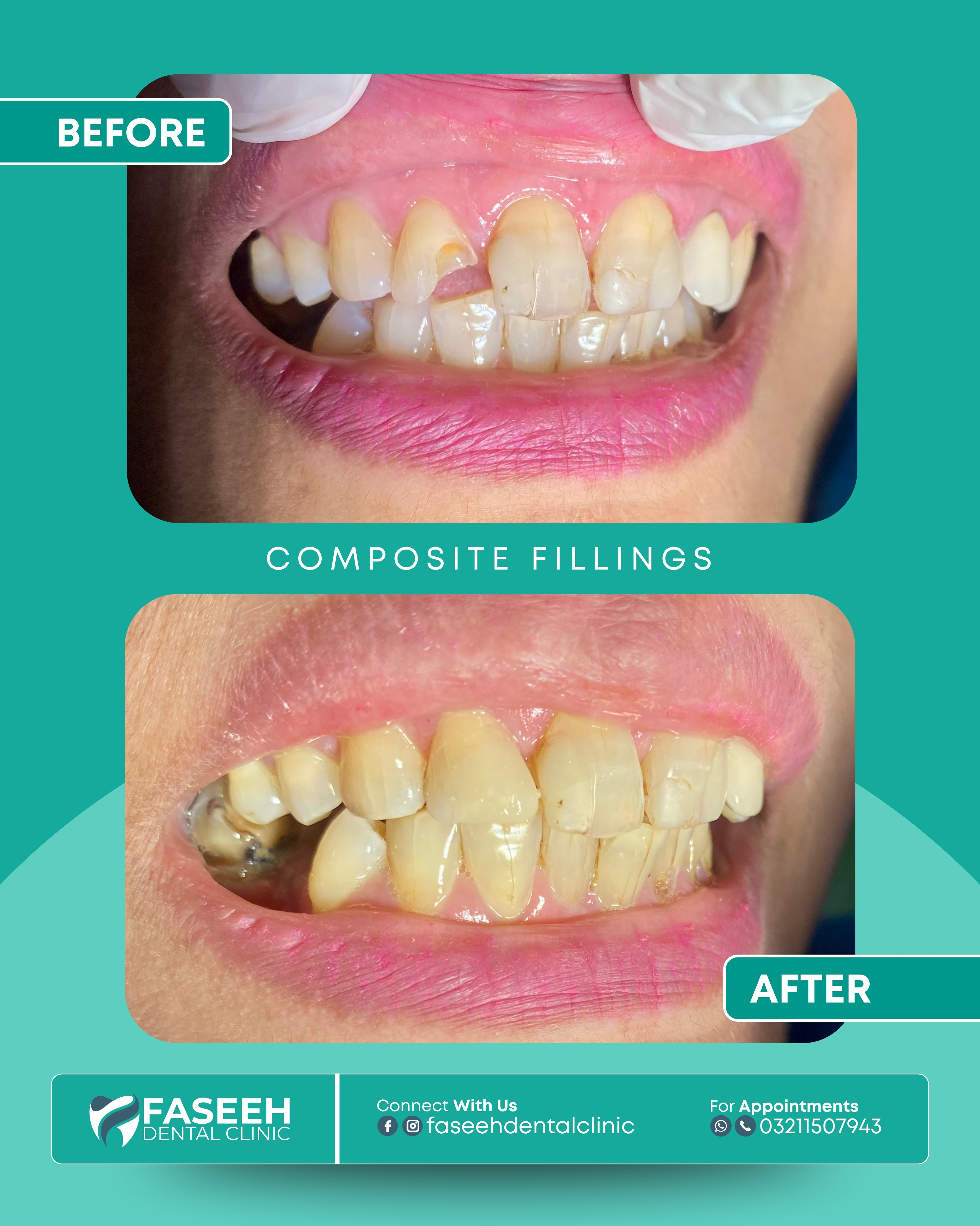 Dental fillings before and after