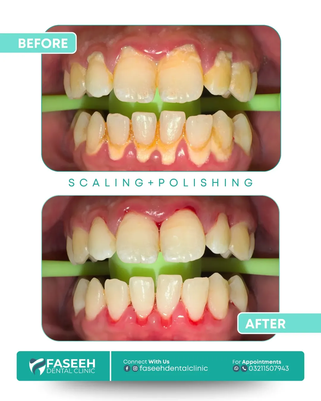 Dental scaling before and after