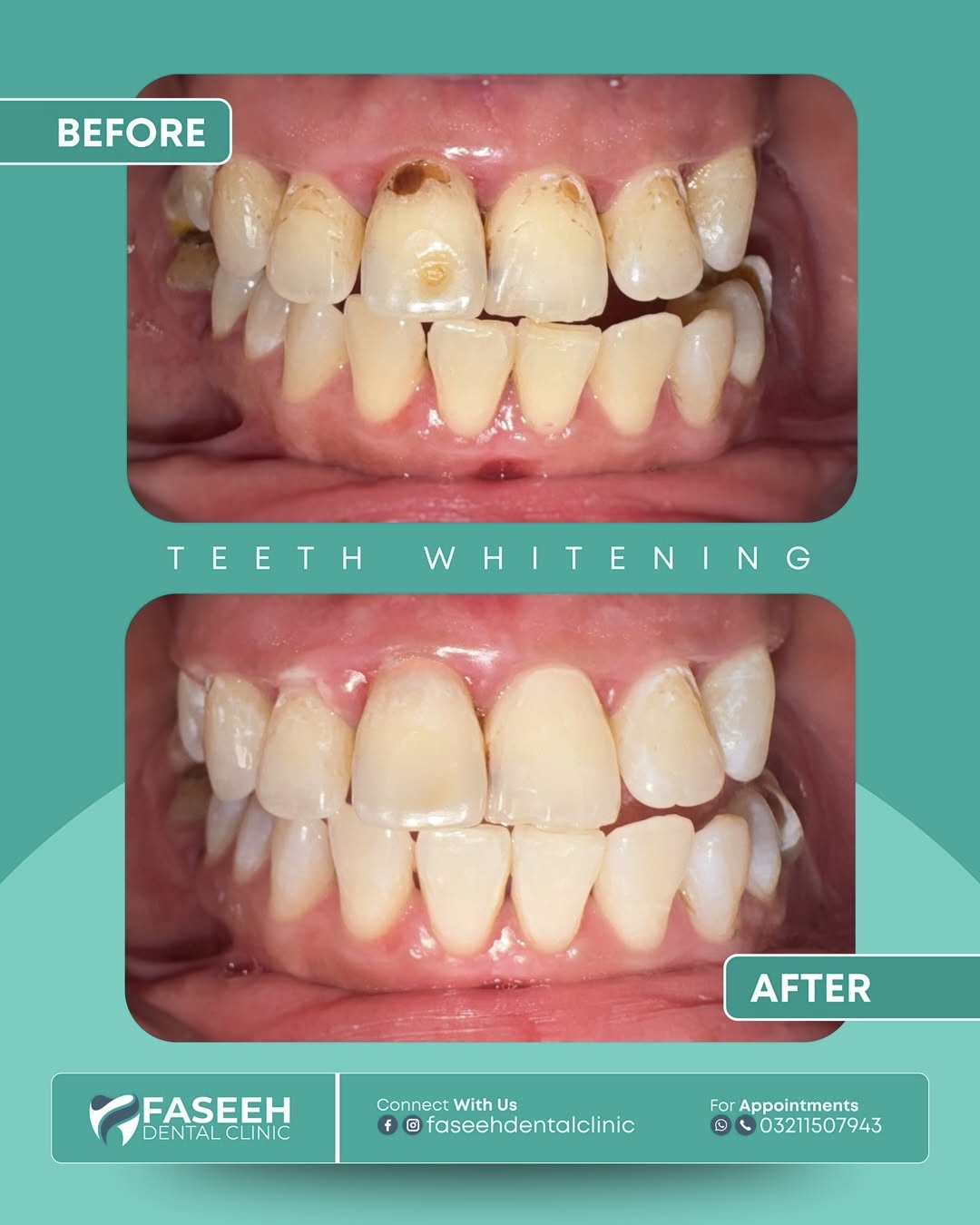 Teeth whitening before and after